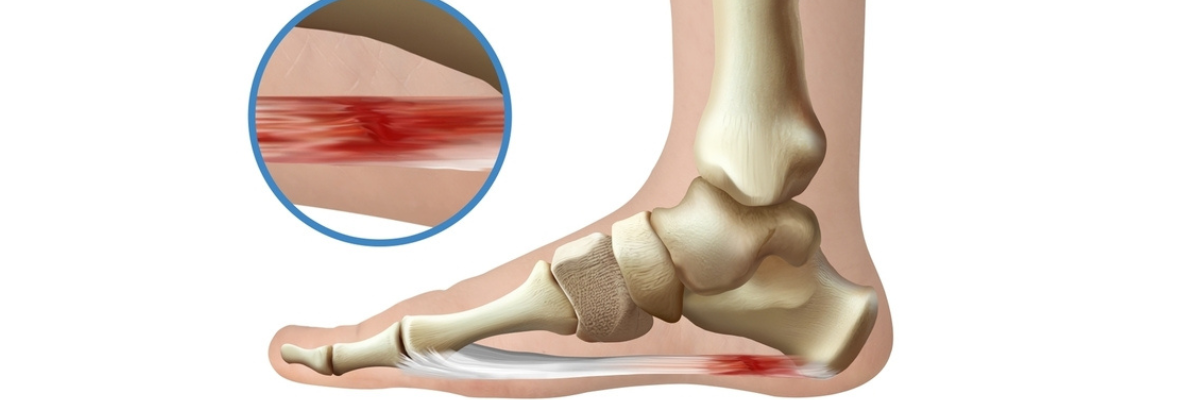 Πελματιαία απονευρωσίτιδα