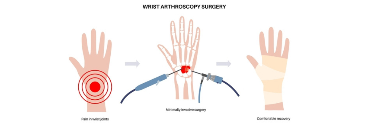 Αρθροσκόπηση καρπού